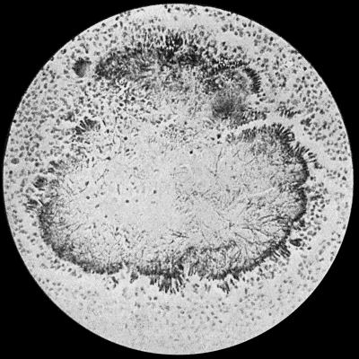 Fig. 30.—Section of Actinomycosis Colony in Pus from Abscess of Liver, showing filaments and clubs of streptothrix actinomyces. × 400 diam. Gram's stain.